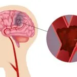 النوبة الإقفارية العابرة أو النوبة الدماغية الصغرى