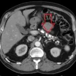 Chronic Pancreatitis